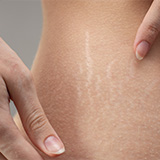 PRP Stretch Mark Meso Injection (3 cc)